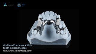 Vitallium Framework ความงามตามธรรมชาติ สวมใส่ง่าย