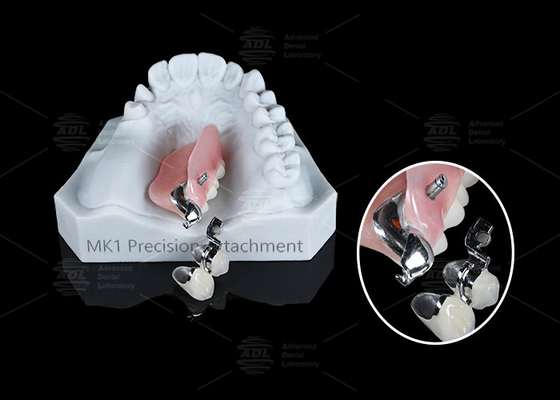 ซื้อ MK1 การติดตั้งความแม่นยํา ปักฟันส่วนย่อยถอนได้ การติดตั้งง่าย การผลิตออนไลน์