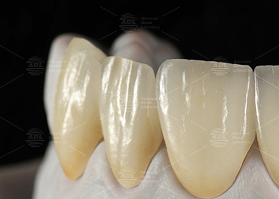 0.3mm-0.7mm Feldspathic EMAX เซรามิก ฟาเนียร์ธรรมชาติ Aesthetic Emax ฟาเนียร์ฟัน