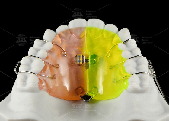 เครื่องขยายรูปพัดลม Orthodontic ให้การขยายส่วนด้านหลังที่ไม่มีการตัด