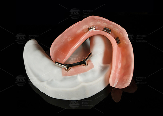 ทิตาเนียมสลัด Snap On โดลเดอร์ อุปกรณ์เสริมทับทิม Bar Overdenture สวยสําหรับรอยยิ้มธรรมชาติ