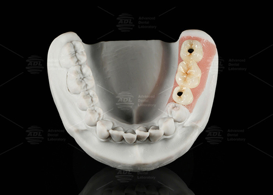 สกรูเก็บทิตาเนียม Custom Abutment โปรเซลีนหลอมไปยัง Zirconia