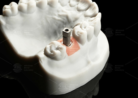 ความแม่นยําไทเทเนียมดิจิตอลอิมพแลนท์สแกนร่างกาย พื้นผิวทรายสําหรับ CAD / CAM