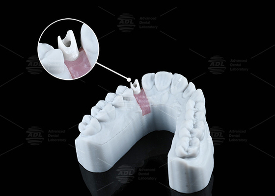 สีขาว Custom Zirconia Abutment สวยธรรมชาติดูและการทํางานที่ดีที่สุด