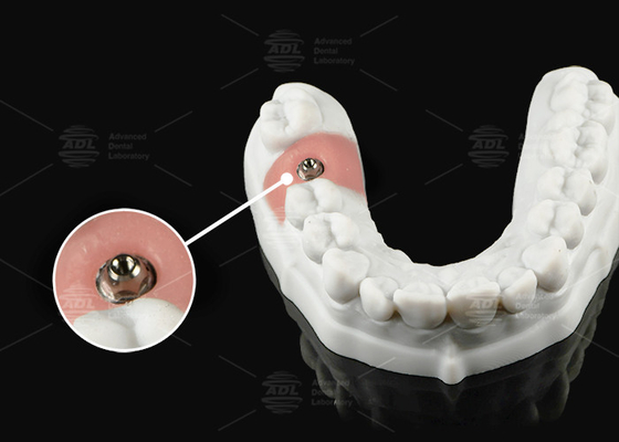 เงินทอง ทิตาเนียม Multi Unit Abutment สําหรับ Single หรือ Multi Unit โปรเทสติก Platform
