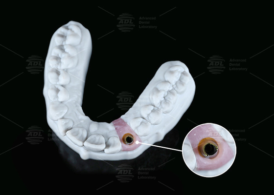 ภายใน Hex Custom Titanium Abutment Screw ซีเมนต์ที่ยังคงมีรูปร่างที่แตกต่างกัน