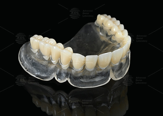 การรักษาความร้อน Vertex Thermosens ฟันเทียมสําหรับผู้ใช้ฟันเทียมเต็มใส