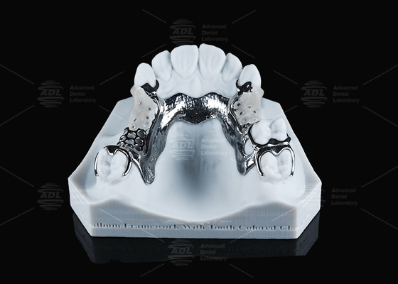 FDA Vitallium Framework With Tooth Colored Clasps สําหรับความสวยงามทางธรรมชาติ