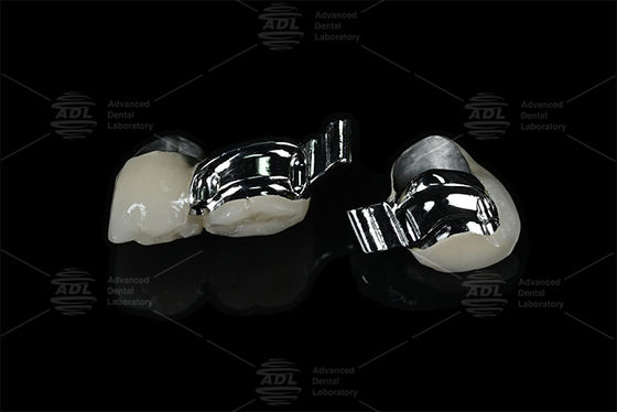 จีน ห้องปฏิบัติการฟัน ปรับเฉพาะผู้ป่วย Keyway ความแม่นยํา การติดตั้งกับ PFM