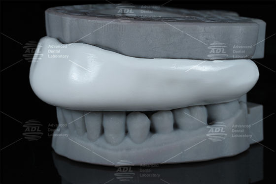 สะดวก Occlusal Splint สปอร์ต การ์ด Bite Splint ออกแบบง่ายในการทําความสะอาด สะดวกสบายอุปกรณ์ป้องกันสําหรับการบดฟัน