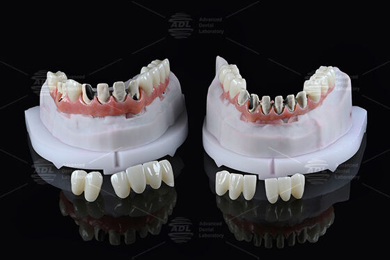 China Dental Lab Titanium Full Arch Hybrid Bridge with Immediate Loading A1 Shade Malong Design Screw Retained Cad/Cam สะพานไฮบริดแบบกระบวนการที่ใช้ได้ทันที