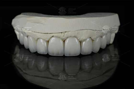 0.3mm-0.7mm Feldspathic EMAX เซรามิก ฟาเนียร์ธรรมชาติ Aesthetic Emax ฟาเนียร์ฟัน